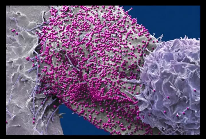 Man Unexpectedly Cured of HIV After Stem Cell Transplant