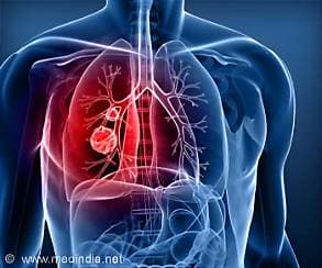 Pope Says Doctors Found a Small Lung Nodule, Recommend Surgery Pope Says Doctors Found a Small Lung Nodule, Recommend Surgery