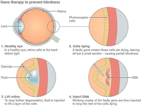 Swiss Gene Therapy for Blindness Shows Further Encouraging Progress Swiss Gene Therapy for Blindness Shows Further Encouraging Progress