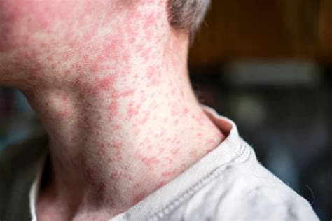 More Than 60 Children Infected in North London Measles Outbreak More Than 60 Children Infected in North London Measles Outbreak