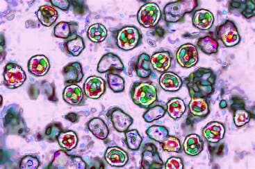 Sixth Measles-Related Death Reported in Pennsylvania Sixth Measles-Related Death Reported in Pennsylvania
