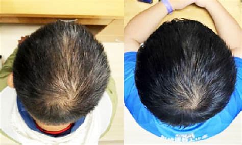 Scientists Invent Plant-Based Serum Proven to Regrow Hair in Weeks Scientists Invent Plant-Based Serum Proven to Regrow Hair in Weeks